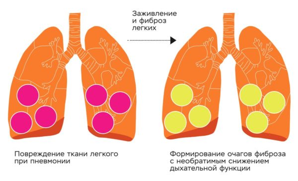 Пневмония при коронавирусе