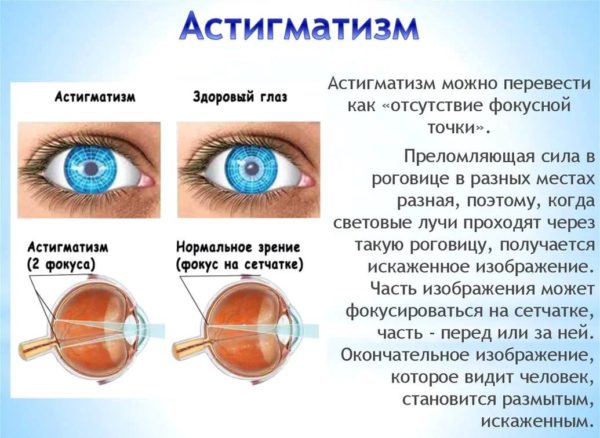 Как лечить астигматизм у взрослых